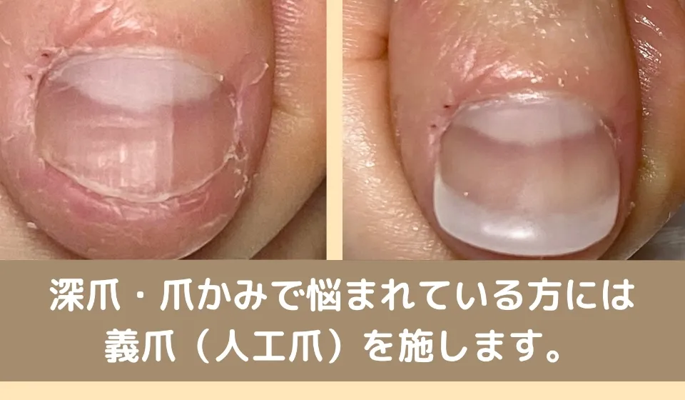 深爪・爪かみで悩まれている方には人工爪を施します